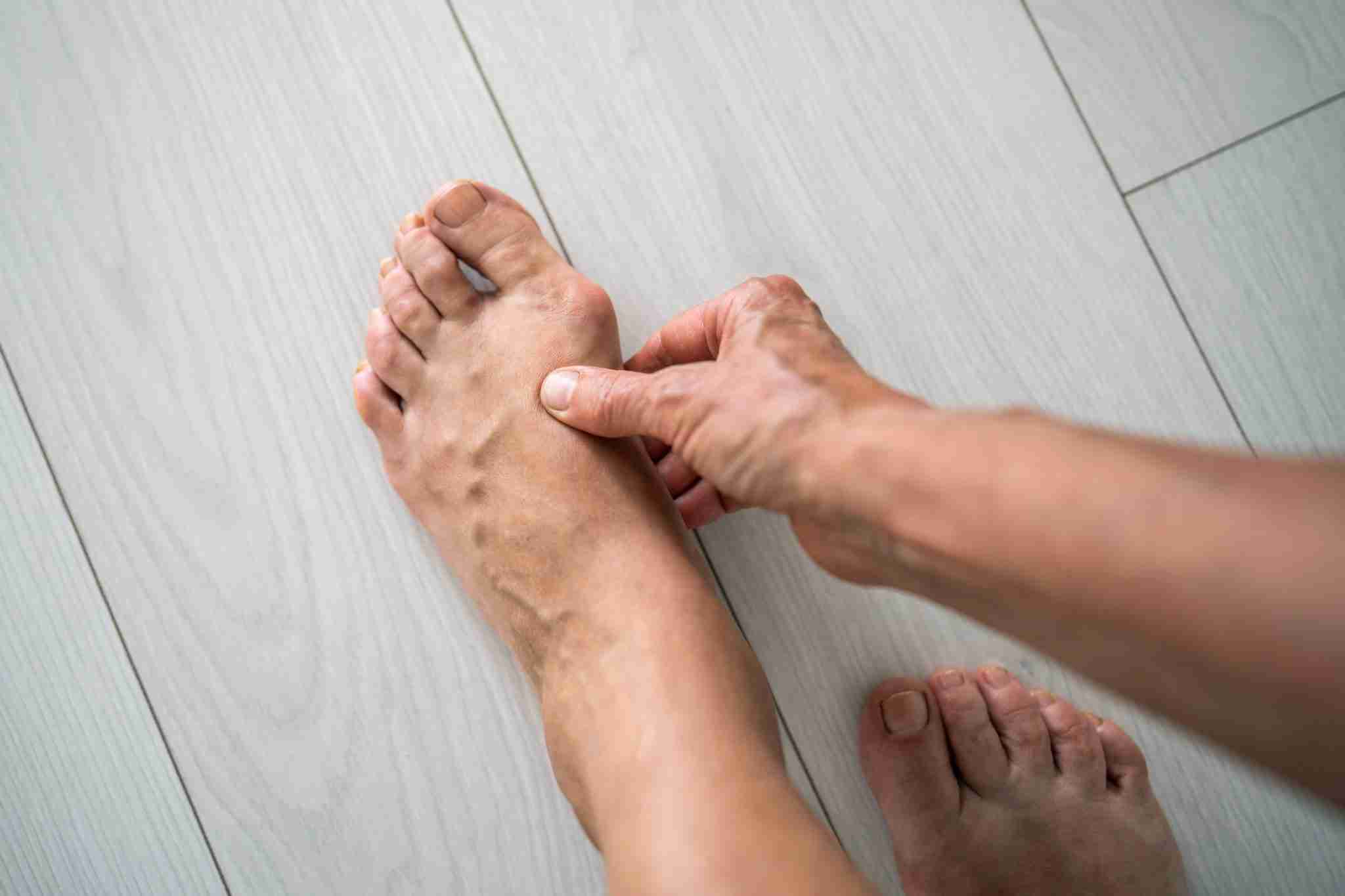 Bunions: Non-Surgical Solutions for Pain Relief